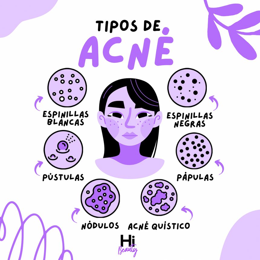 Tipos de acné y cómo identificarlos