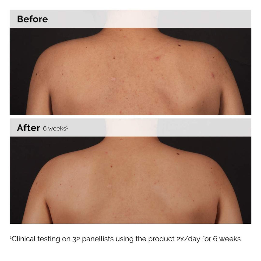 Serum de Cuerpo para Acné The Ordinary Salicylic Acid 0.5% Body 240ml