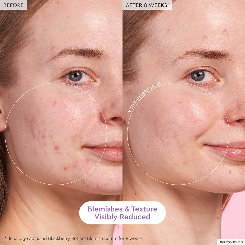 Sérum de Retinol Glow Recipe Blackberry Retinol Blemish Serum 30ml